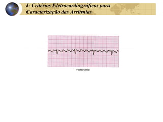 I- Critérios Eletrocardiográficos para
Caracterização das Arritmias
 