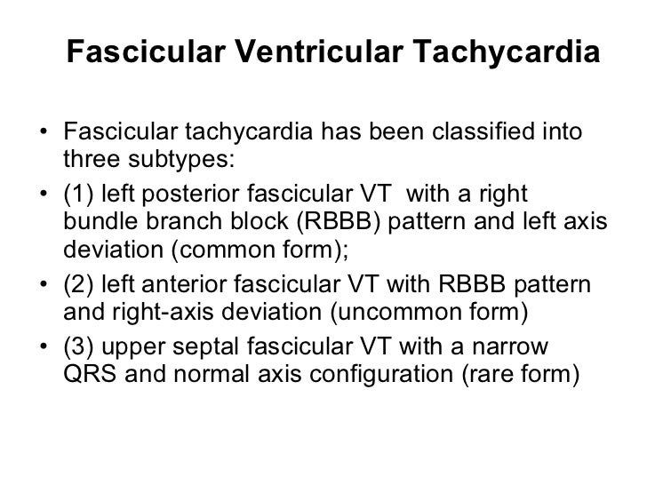 Ecg fascicular vt