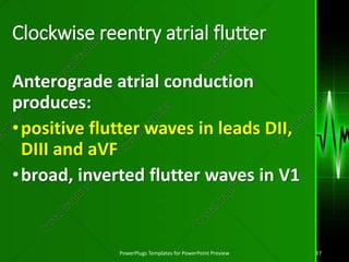 Inverted A Flutter ECG A: first part. | PPSX