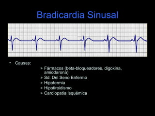 Bradicardia Sinusal



•   Causas:
              » Fármacos (beta-bloqueadores, digoxina,
                amiodarona)
              » Sd. Del Seno Enfermo
              » Hipotermia
              » Hipotiroidismo
              » Cardiopatía isquémica
 
