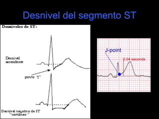 Desnivel del segmento ST
 