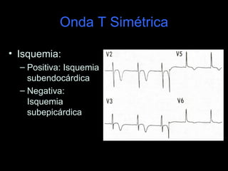 Onda T Simétrica

• Isquemia:
  – Positiva: Isquemia
    subendocárdica
  – Negativa:
    Isquemia
    subepicárdica
 