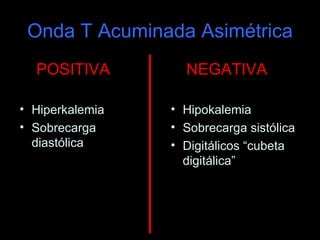 Onda T Acuminada Asimétrica
  POSITIVA         NEGATIVA

• Hiperkalemia   • Hipokalemia
• Sobrecarga     • Sobrecarga sistólica
  diastólica     • Digitálicos “cubeta
                   digitálica”
 