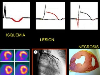 ISQUEMIA
           LESIÓN
                    NECROSIS
 
