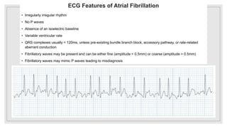 ECG : a case based discussion | PPTX