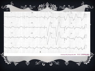 Hyperkalemia
 