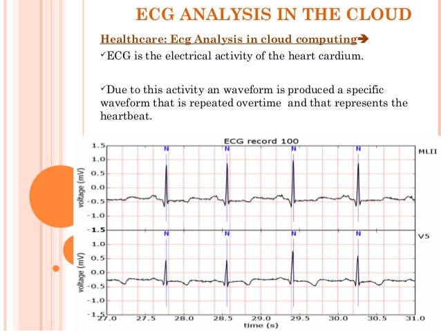 ECG ANALYSIS IN CLOUD COMPUTING
