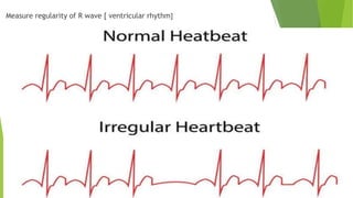 ECG analysis on normal sinus rhythm and atrial arrhythmias.pptx
