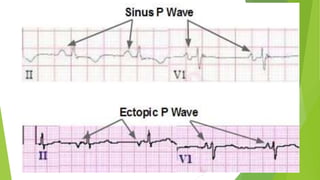 Sinus R1 ECG analysis on normal sinus rhythm and atrial arrhythmias.pptx