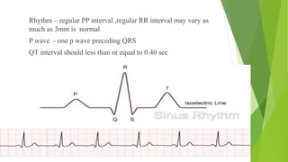 Normal Rr Interval Ekg ECG analysis on normal sinus rhythm and atrial arrhythmias.pptx