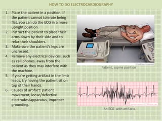 1. Place the patient in a position. If
the patient cannot tolerate being
flat, you can do the ECG in a more
upright position.
2. Instruct the patient to place their
arms down by their side and to
relax their shoulders.
3. Make sure the patient's legs are
uncrossed.
4. Remove any electrical devices, such
as cell phones, away from the
patient as they may interfere with
the machine.
5. If you're getting artifact in the limb
leads, try having the patient sit on
top of their hands.
6. Causes of artifact: patient
movement, loose/defective
electrodes/apparatus, improper
grounding.
HOW TO DO ELECTROCARDIOGRAPHY
An ECG with artifacts.
Patient, supine position
 