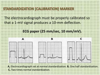The electrocardiograph must be properly calibrated so
that a 1-mV signal produces a 10-mm deflection.
ECG paper (25 mm/sec, 10 mm/mV).
A, Electrocardiograph set at normal standardization. B, One half standardization.
C, Two times normal standardization.
 
