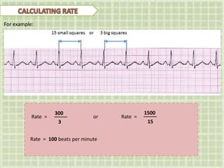300
Rate =
For example:
3
1500
15
Rate =or
Rate = 100 beats per minute
 