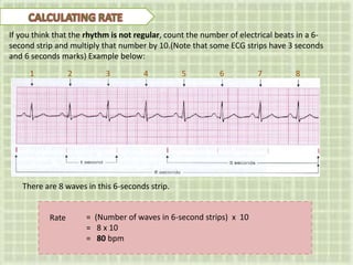 If you think that the rhythm is not regular, count the number of electrical beats in a 6-
second strip and multiply that number by 10.(Note that some ECG strips have 3 seconds
and 6 seconds marks) Example below:
1 2 3 4 5 6 7 8
= (Number of waves in 6-second strips) x 10
= 8 x 10
= 80 bpm
Rate
There are 8 waves in this 6-seconds strip.
 