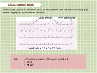 You can also count the number of beats on any one row over the ten-second strip (the
whole lenght) and multiply by 6. Example:
= (Number of waves in 10-second strips) x 6
= 13 x 6
= 78 bpm
Rate
 