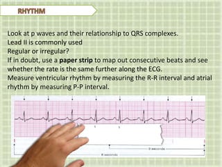 Look at p waves and their relationship to QRS complexes.
Lead II is commonly used
Regular or irregular?
If in doubt, use a paper strip to map out consecutive beats and see
whether the rate is the same further along the ECG.
Measure ventricular rhythm by measuring the R-R interval and atrial
rhythm by measuring P-P interval.
 