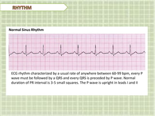 ECG rhythm characterized by a usual rate of anywhere between 60-99 bpm, every P
wave must be followed by a QRS and every QRS is preceded by P wave. Normal
duration of PR interval is 3-5 small squares. The P wave is upright in leads I and II
Normal Sinus Rhythm
 