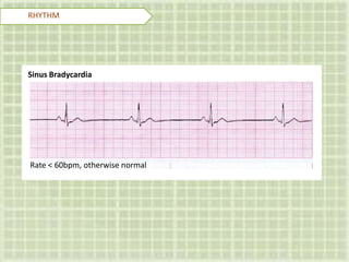 Sinus Bradycardia
RHYTHM
Rate < 60bpm, otherwise normal
 