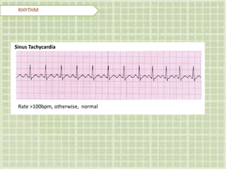 RHYTHM
Sinus Tachycardia
Rate >100bpm, otherwise, normal
 