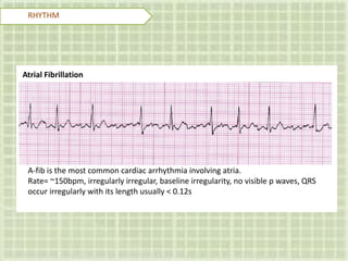 RHYTHM
Atrial Fibrillation
A-fib is the most common cardiac arrhythmia involving atria.
Rate= ~150bpm, irregularly irregular, baseline irregularity, no visible p waves, QRS
occur irregularly with its length usually < 0.12s
 
