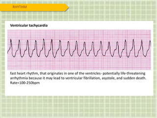RHYTHM
Ventricular tachycardia
fast heart rhythm, that originates in one of the ventricles- potentially life-threatening
arrhythmia because it may lead to ventricular fibrillation, asystole, and sudden death.
Rate=100-250bpm
 