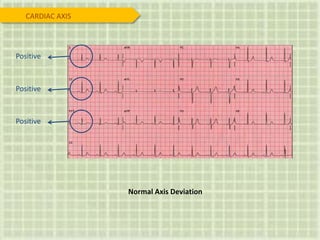 Positive
Positive
Positive
Normal Axis Deviation
CARDIAC AXIS
 