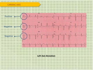 Positive
Negative
Negative
Left Axis Deviation
CARDIAC AXIS
 