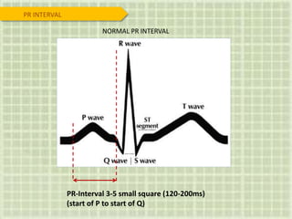 PR INTERVAL
NORMAL PR INTERVAL
PR-Interval 3-5 small square (120-200ms)
(start of P to start of Q)
 