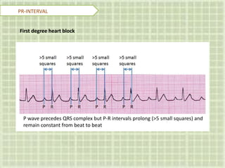 PR-INTERVAL
First degree heart block
P wave precedes QRS complex but P-R intervals prolong (>5 small squares) and
remain constant from beat to beat
 