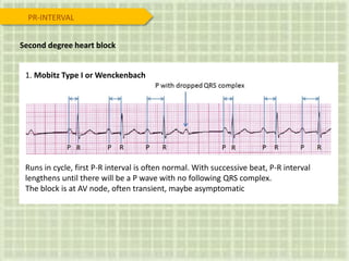 Second degree heart block
1. Mobitz Type I or Wenckenbach
Runs in cycle, first P-R interval is often normal. With successive beat, P-R interval
lengthens until there will be a P wave with no following QRS complex.
The block is at AV node, often transient, maybe asymptomatic
PR-INTERVAL
 