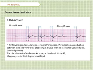 Second degree heart block
2. Mobitz Type 2
P-R interval is constant, duration is normal/prolonged. Periodically, no conduction
between atria and ventricles- producing a p wave with no associated QRS complex.
(blocked p wave).
The block is most often below AV node, at bundle of His or BB,
May progress to third degree heart block
PR-INTERVAL
 