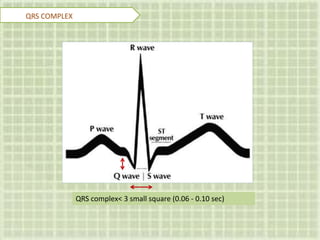 QRS complex< 3 small square (0.06 - 0.10 sec)
QRS COMPLEX
 