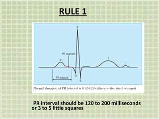 RULE 1
PR interval should be 120 to 200 milliseconds
or 3 to 5 little squares
 