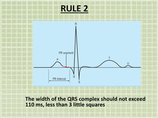 RULE 2
The width of the QRS complex should not exceed
110 ms, less than 3 little squares
 