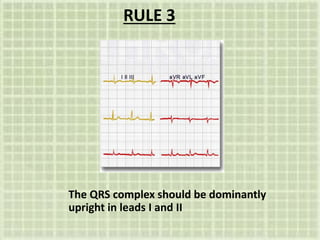 RULE 3
The QRS complex should be dominantly
upright in leads I and II
 