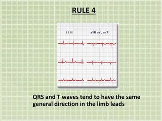 RULE 4
QRS and T waves tend to have the same
general direction in the limb leads
 