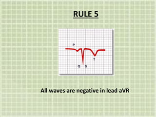 RULE 5
All waves are negative in lead aVR
 
