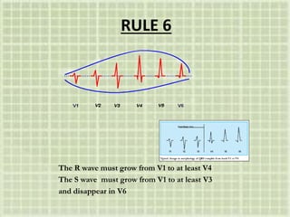 RULE 6
The R wave must grow from V1 to at least V4
The S wave must grow from V1 to at least V3
and disappear in V6
 