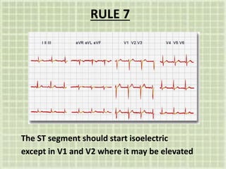 RULE 7
The ST segment should start isoelectric
except in V1 and V2 where it may be elevated
 