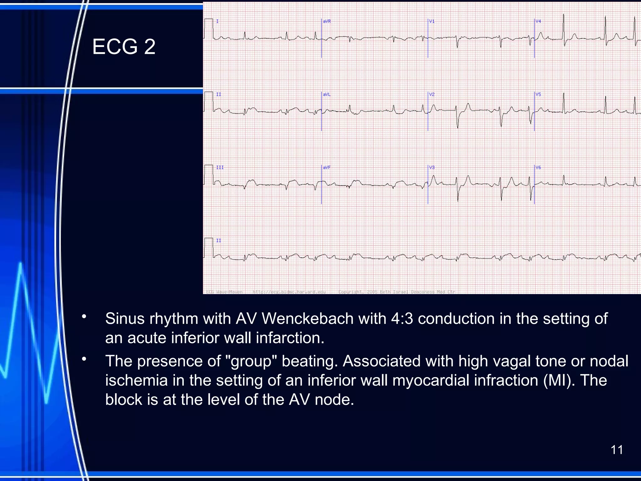 ECG 2
• Sinus rhythm with AV Wenckebach with 4:3 conduction in the setting of
an acute inferior wall infarction.
• The presence of "group" beating. Associated with high vagal tone or nodal
ischemia in the setting of an inferior wall myocardial infraction (MI). The
block is at the level of the AV node.
11
 