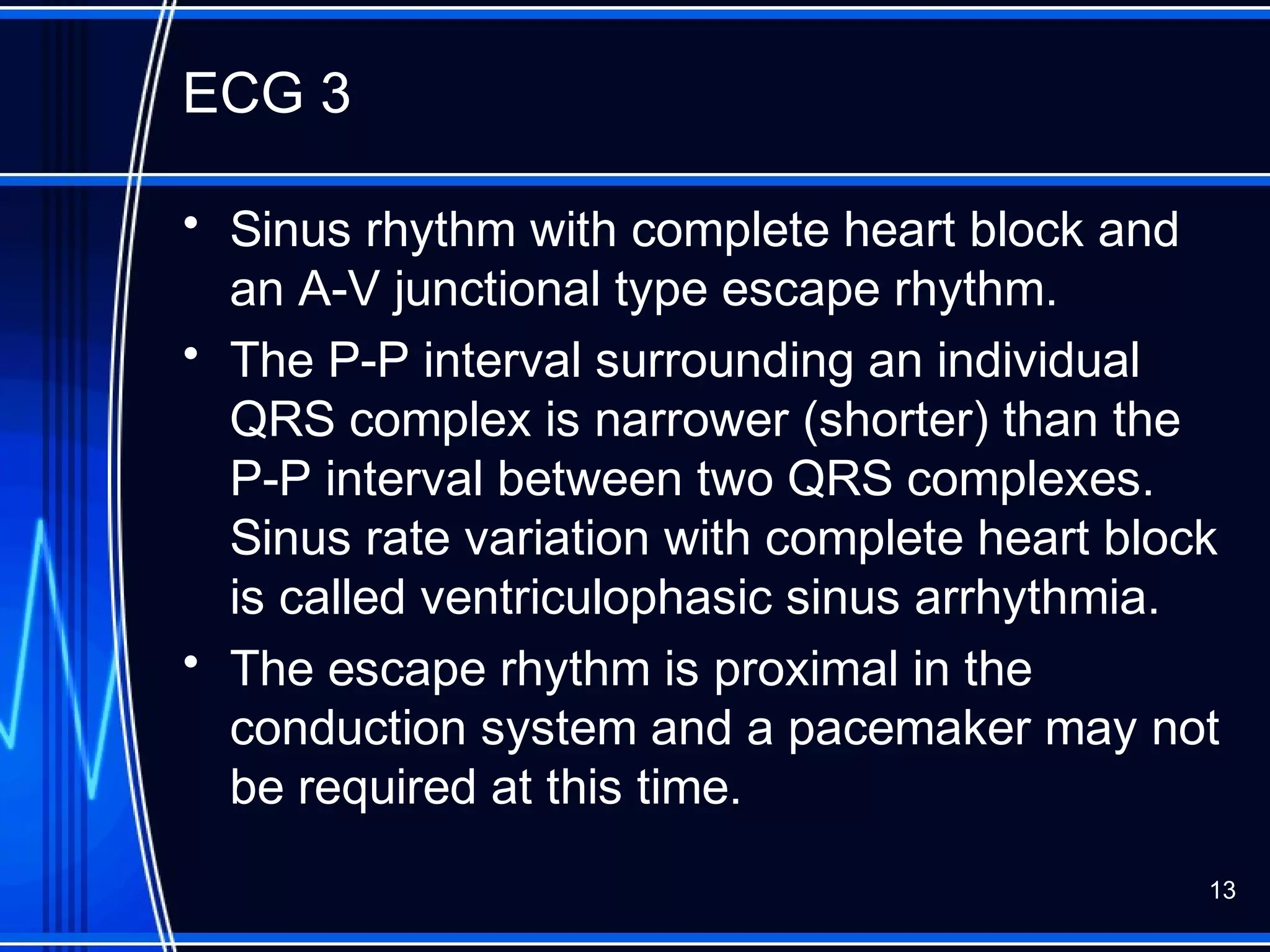 ECG 3
• Sinus rhythm with complete heart block and
an A-V junctional type escape rhythm.
• The P-P interval surrounding an individual
QRS complex is narrower (shorter) than the
P-P interval between two QRS complexes.
Sinus rate variation with complete heart block
is called ventriculophasic sinus arrhythmia.
• The escape rhythm is proximal in the
conduction system and a pacemaker may not
be required at this time.
13
 