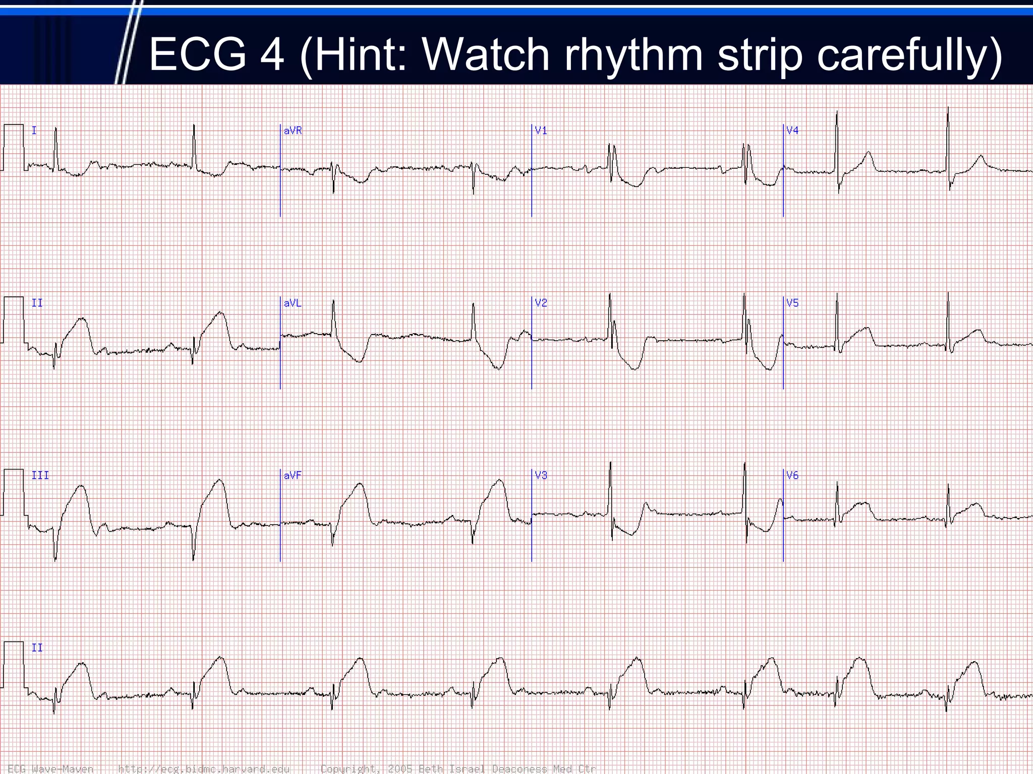 ECG 4 (Hint: Watch rhythm strip carefully)
15
 