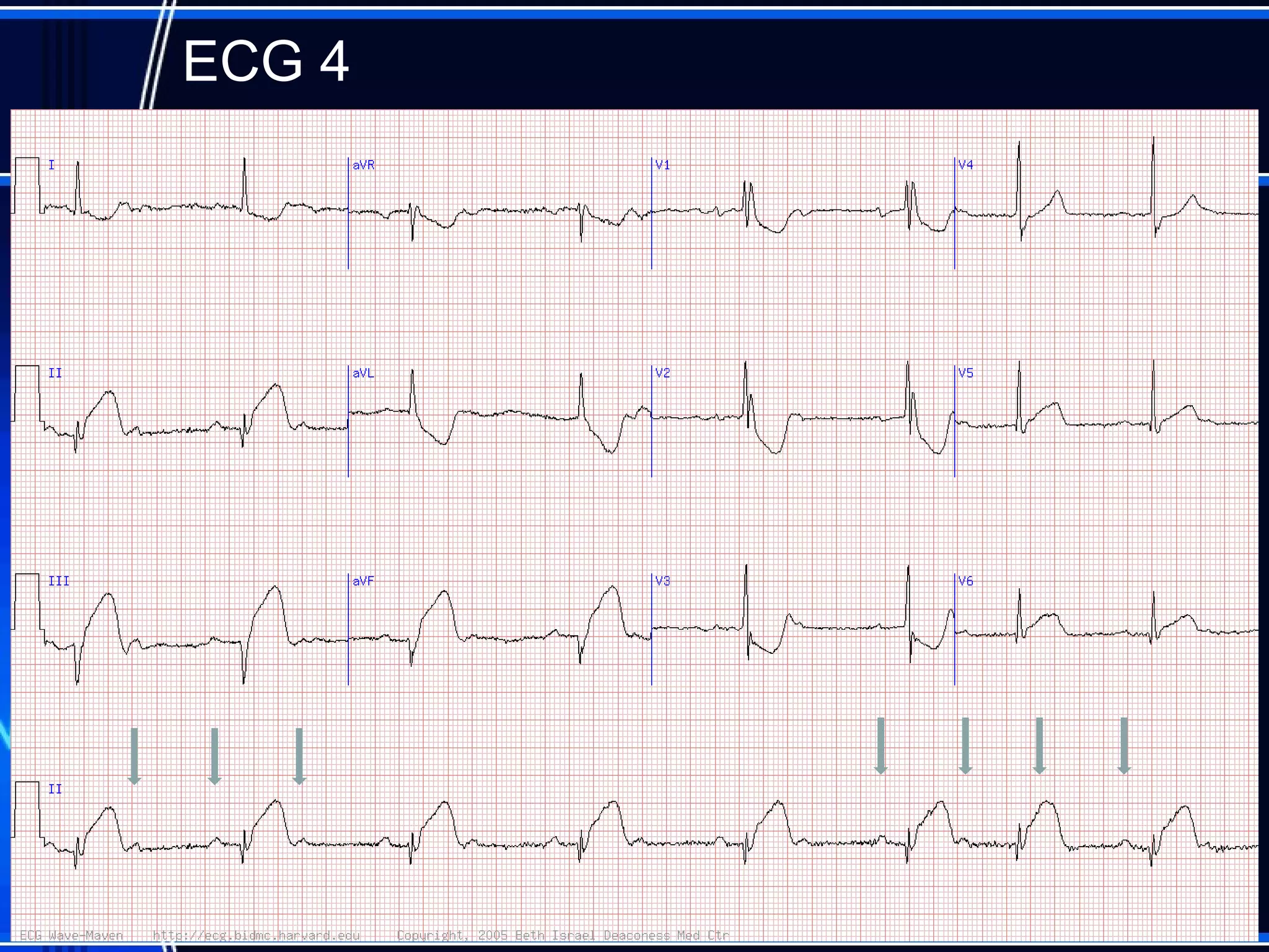 ECG 4
17
 