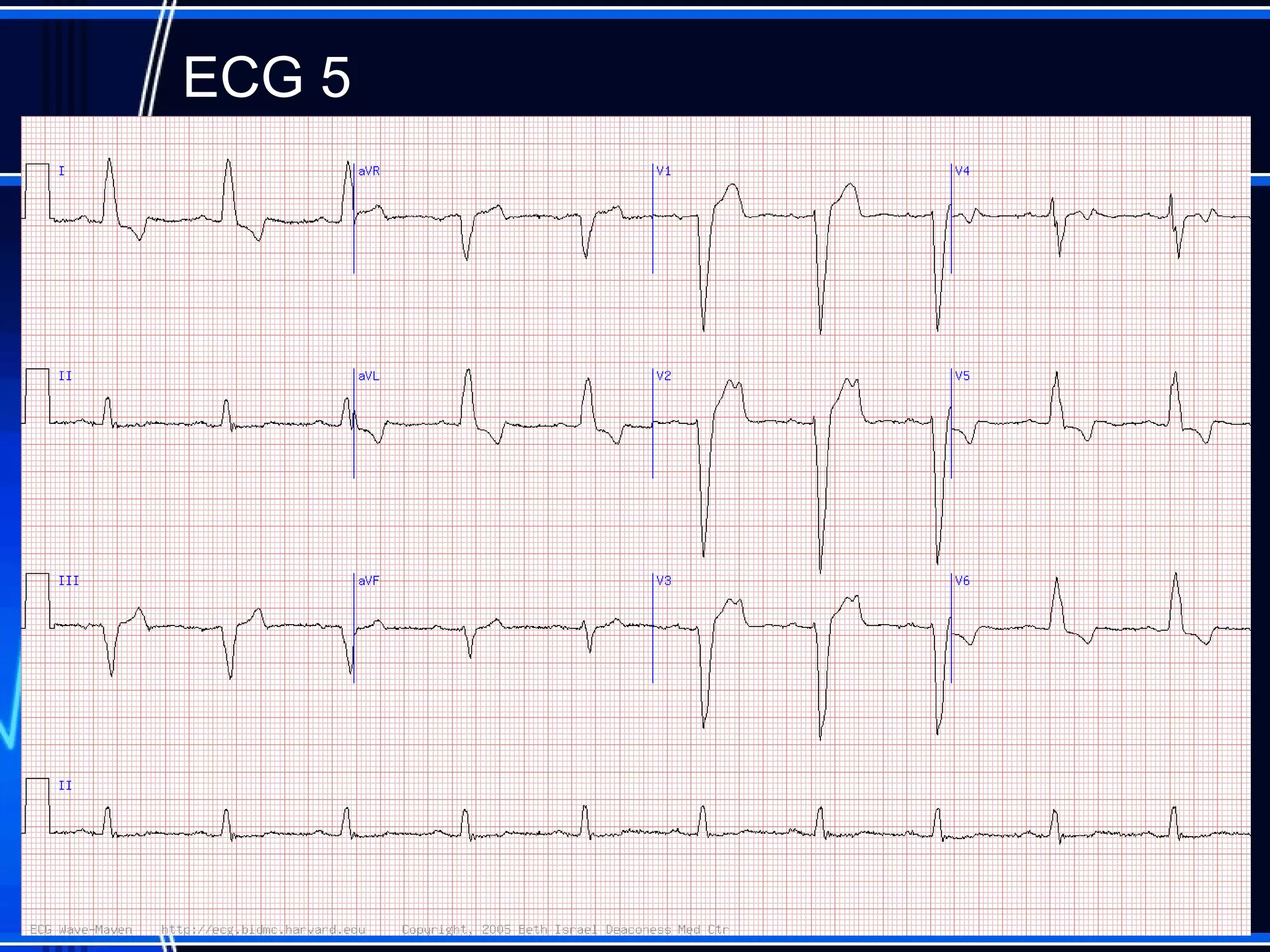 ECG 5
 