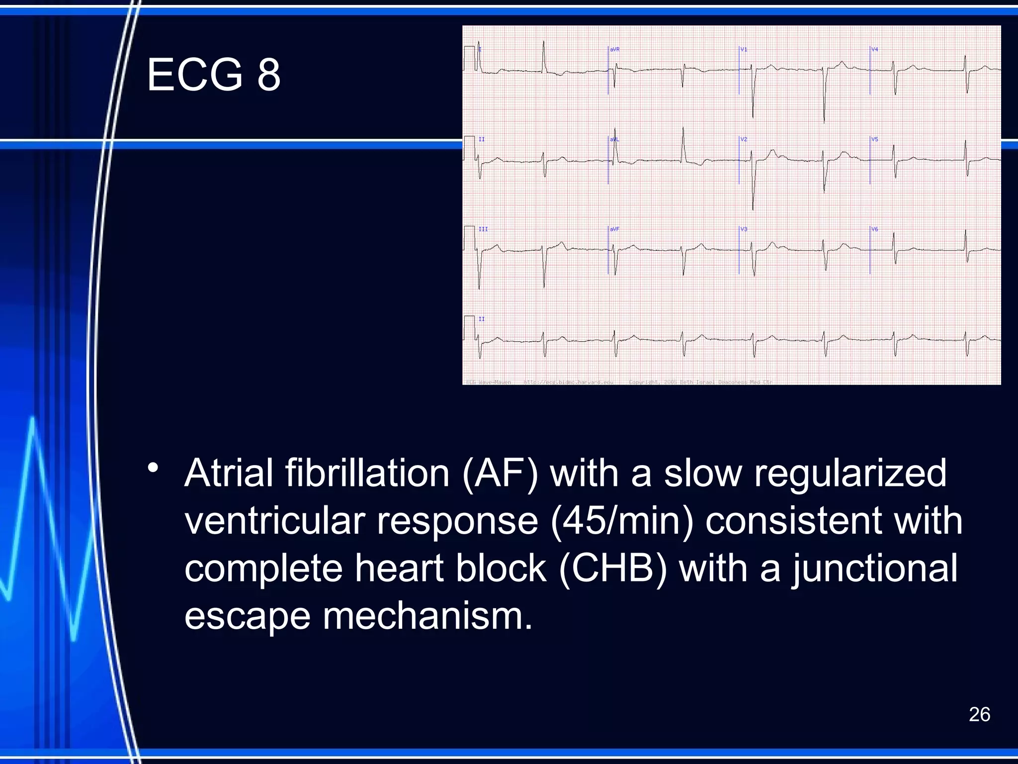 ECG 8
• Atrial fibrillation (AF) with a slow regularized
ventricular response (45/min) consistent with
complete heart block (CHB) with a junctional
escape mechanism.
26
 