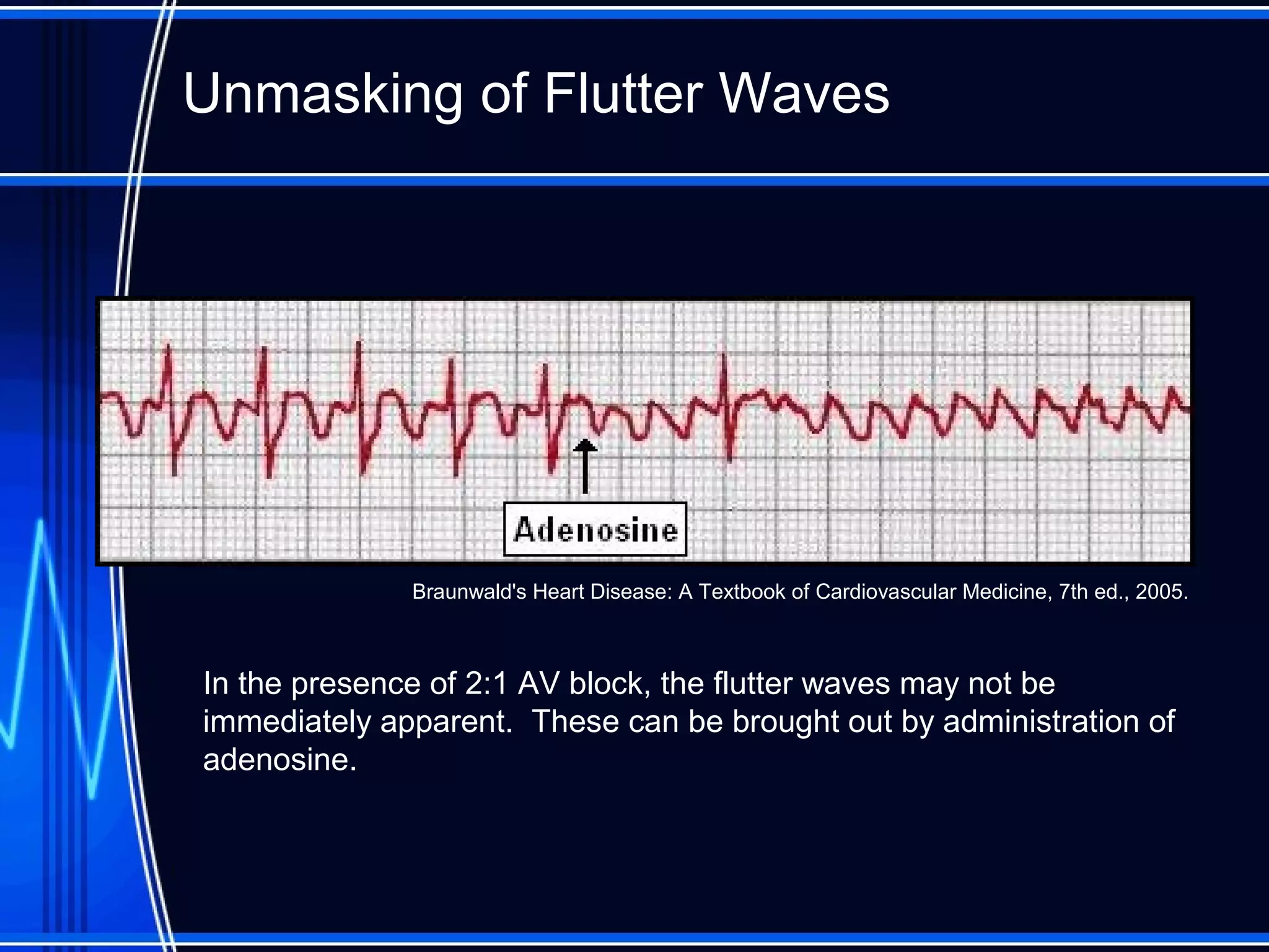 Unmasking of Flutter Waves
In the presence of 2:1 AV block, the flutter waves may not be
immediately apparent. These can be brought out by administration of
adenosine.
Braunwald's Heart Disease: A Textbook of Cardiovascular Medicine, 7th ed., 2005.
 