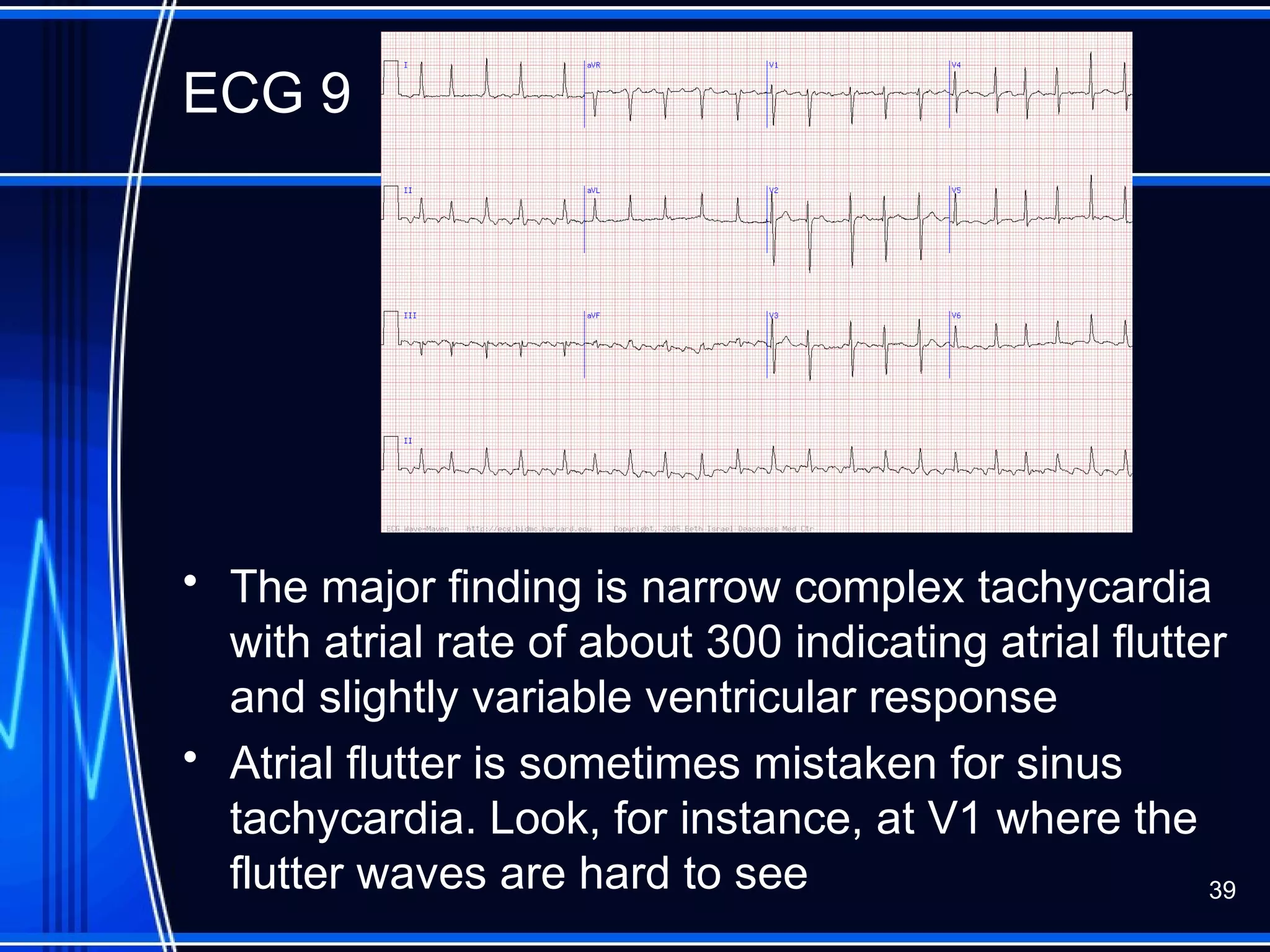 ECG 9
• The major finding is narrow complex tachycardia
with atrial rate of about 300 indicating atrial flutter
and slightly variable ventricular response
• Atrial flutter is sometimes mistaken for sinus
tachycardia. Look, for instance, at V1 where the
flutter waves are hard to see 39
 