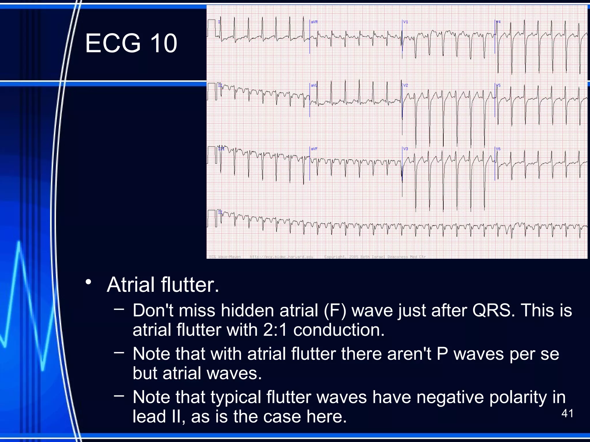 ECG 10
• Atrial flutter.
– Don't miss hidden atrial (F) wave just after QRS. This is
atrial flutter with 2:1 conduction.
– Note that with atrial flutter there aren't P waves per se
but atrial waves.
– Note that typical flutter waves have negative polarity in
lead II, as is the case here. 41
 
