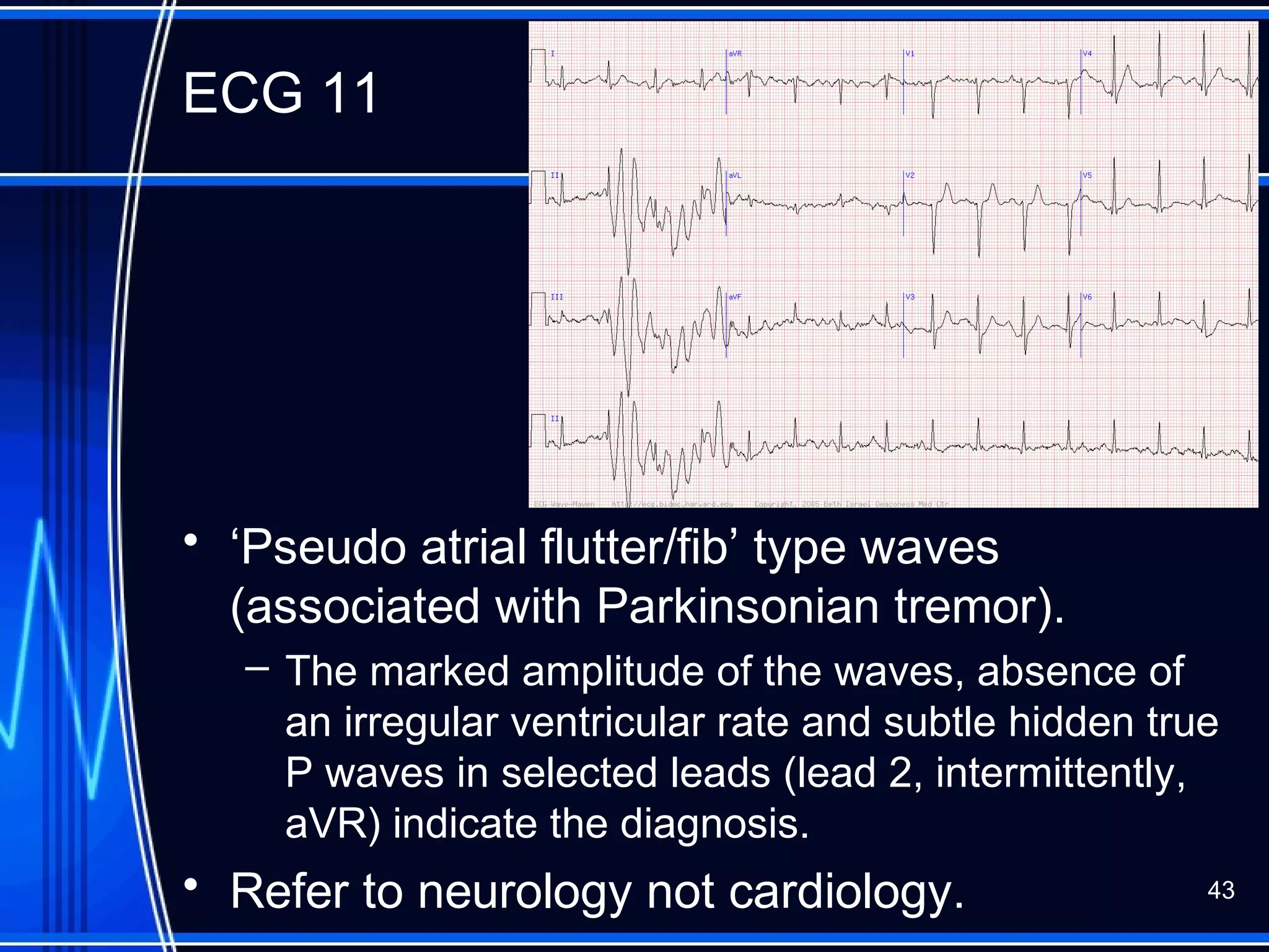 ECG 11
• ‘Pseudo atrial flutter/fib’ type waves
(associated with Parkinsonian tremor).
– The marked amplitude of the waves, absence of
an irregular ventricular rate and subtle hidden true
P waves in selected leads (lead 2, intermittently,
aVR) indicate the diagnosis.
• Refer to neurology not cardiology. 43
 