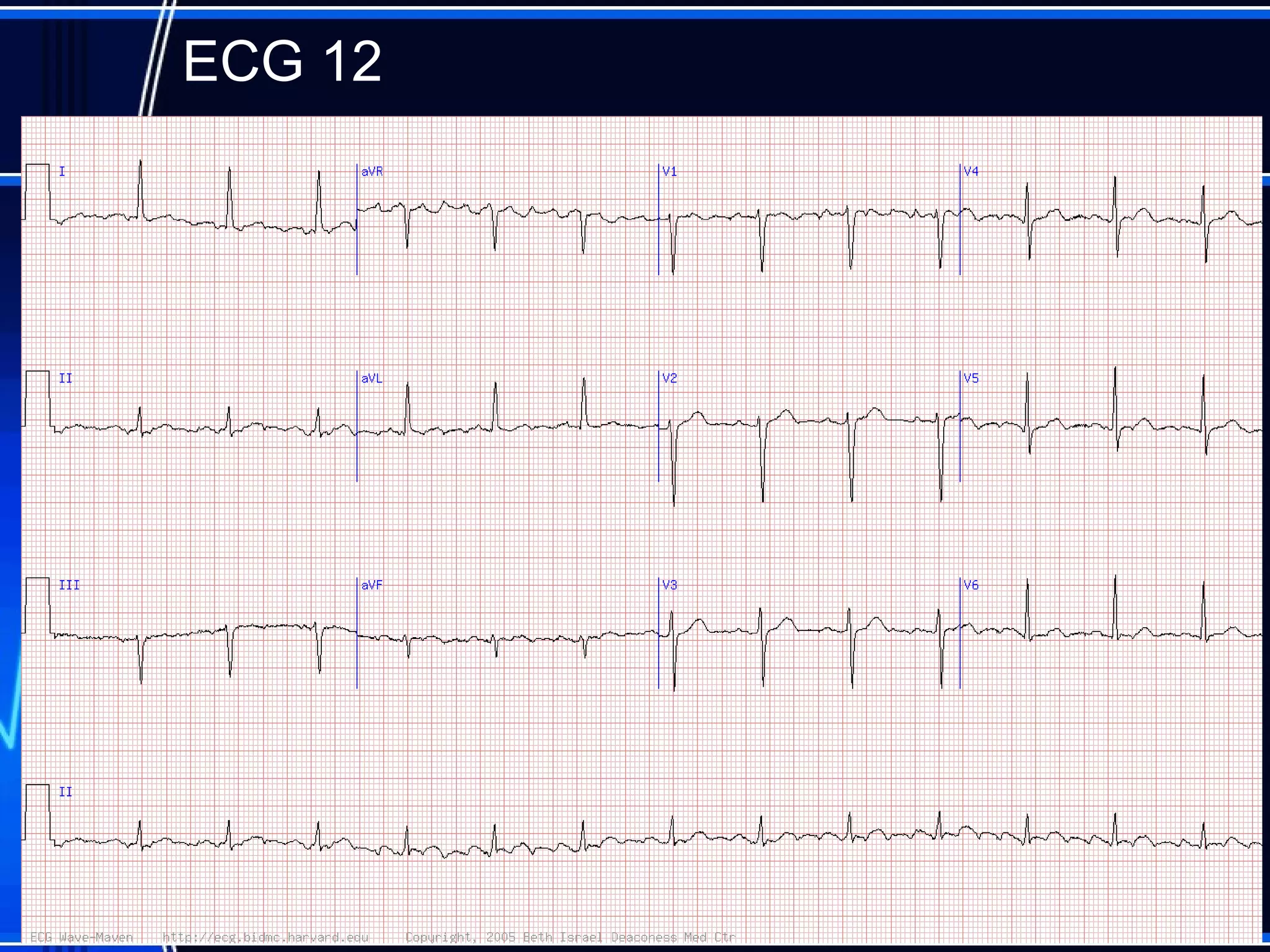 ECG 12
44
 